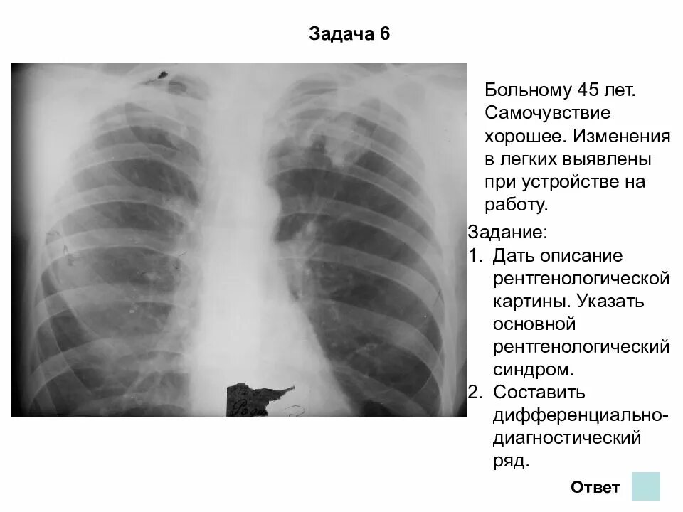 Какие изменения в легких. Возрастные изменения легких. флюорография возрастные изменения в легких что это такое. возрастные изменения легких на рентгенограмме.