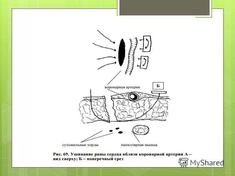 ушивание раны сердца техника. шов рана сердца. шов рана сердца. метод временного гемостаза. наложение швов держалок.