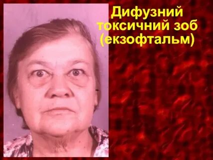 Уровень диффузного зоба