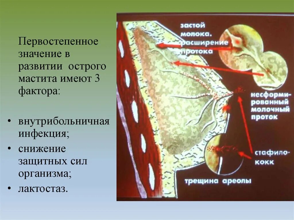 Лечение гнойного мастита. Гнойный лактационный мастит. Нелактационный Гнойный мастит.