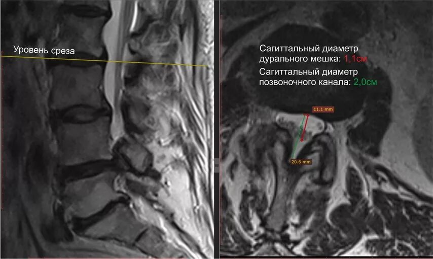 грыжа шморля l5 позвоночника. дуральный мешок дискогенно деформирован l5-s1. дуральный мешок шейного отдела. дуральный мешок позвоночника компремирован. дуральный мешок спинного мозга.