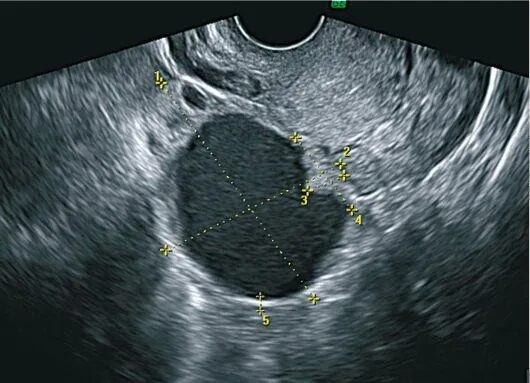 Образование округлое в яичнике. Муцинозная опухоль яичника на УЗИ. Псевдомуцинозная киста. Муцинозная киста яичника на УЗИ. Серозная цистаденома яичника на УЗИ.