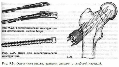 Остеосинтез классификация