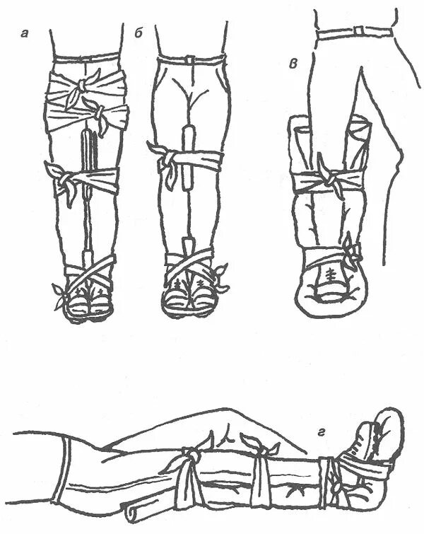 Накладывание шины при переломе костей голени. Иммобилизация переломов Крамера. Накладывание шины при переломе колена. Шинирование при переломах конечностей.