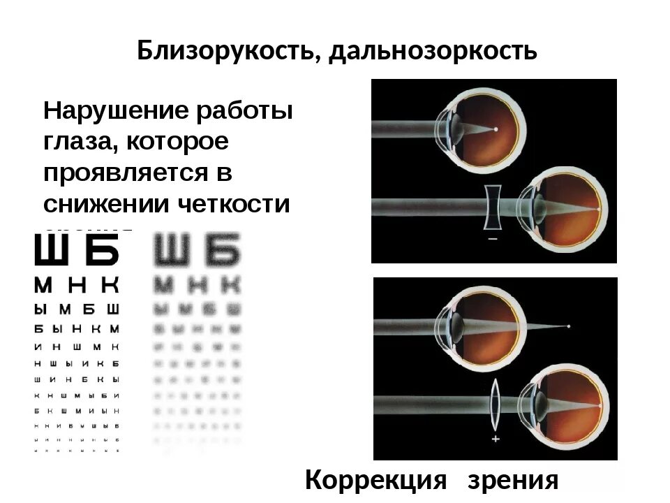 Острота зрения близорукость и дальнозоркость. Строение глаза дальнозоркость. Нарушение зрения таблица астигматизм. Миопия и дальнозоркость. Миопия что это простыми словами