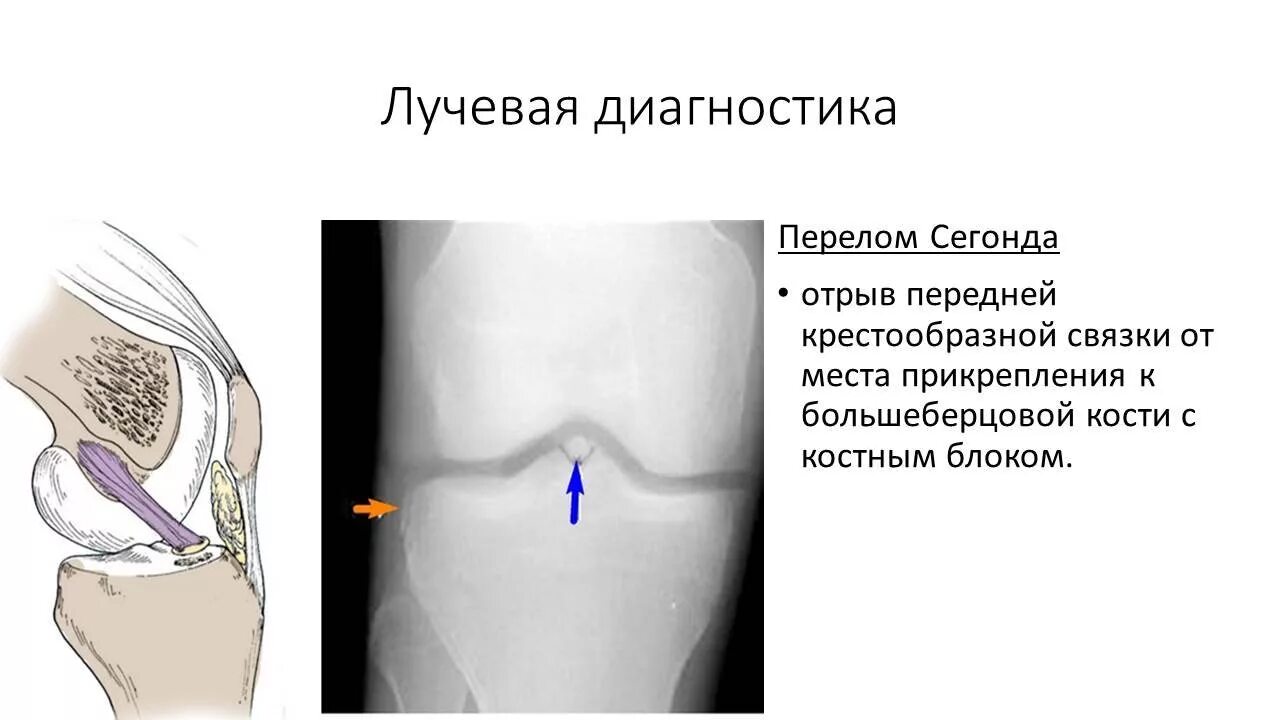 Перелом надколенника операции. Крестовидная связка коленного сустава травма. Разрыв передней крестообразной связки рентген. МР картина тотального разрыва передней крестообразной связки. Разрыв крестообразных связок рентген.