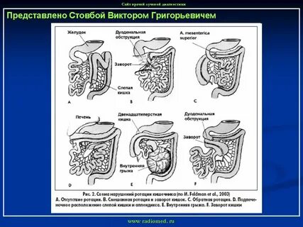 Развитие толстого кишечника
