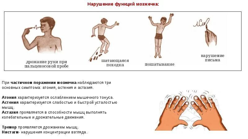 Атония мышц это. Ослабление тонуса мышц. мышечный тонус при поражении мозжечка. атония мышц. тонус мышц атония.