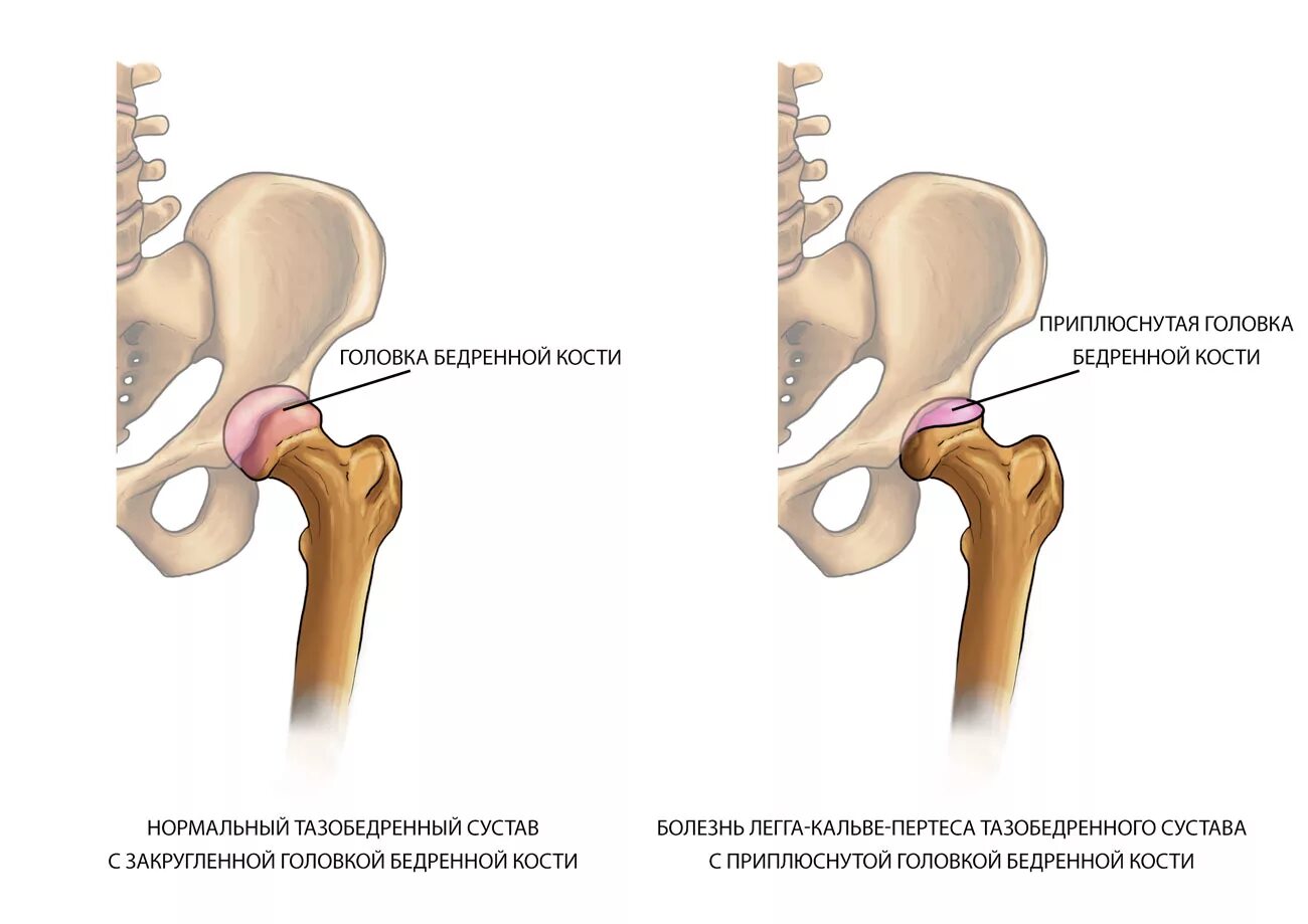 Тазобедренный сустав лечение врач. Болезнь Пертеса тазобедренного сустава. Болезнь Легга Кальве Пертеса. Уплощена головка бедренной кости. Болезнь лега-Кальве-Пертеса.