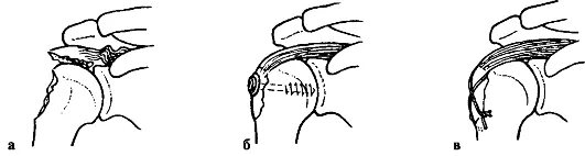 переломы плеча смещение бугорка. изолированный перелом большого бугорка плечевой кости рентген. перелом большого бугорка плечевой кости рентген. отрыв большого бугорка правой плечевой кости. изолированный перелом малого бугорка плечевой кости рентген.