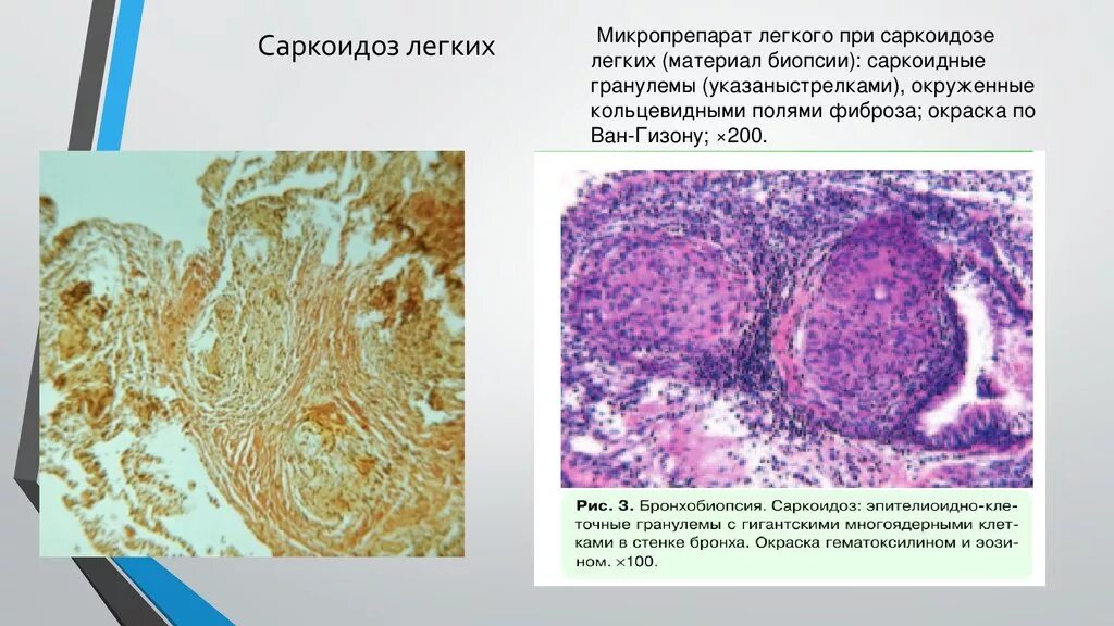 Саркоидная гранулема. Саркоидоз легкого гистология. Эпителиоидноклеточные гранулемы. Гранулема при саркоидозе микропрепарат описание. Гранулема при саркоидозе микропрепарат.