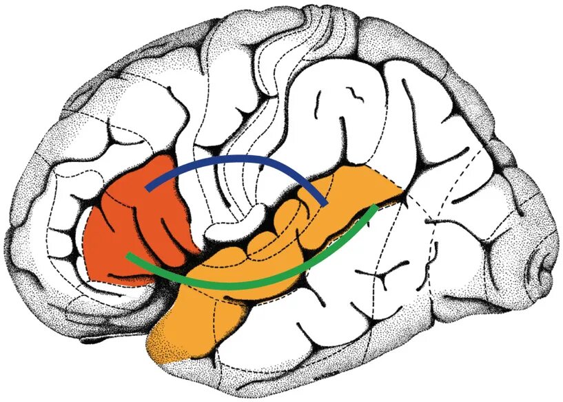 Очаги в коре головного мозга. Мозг центр Брока и Вернике. Алалия Вернике Брока. Головной мозг зоны Вернике. Зона Брока и зона Вернике.