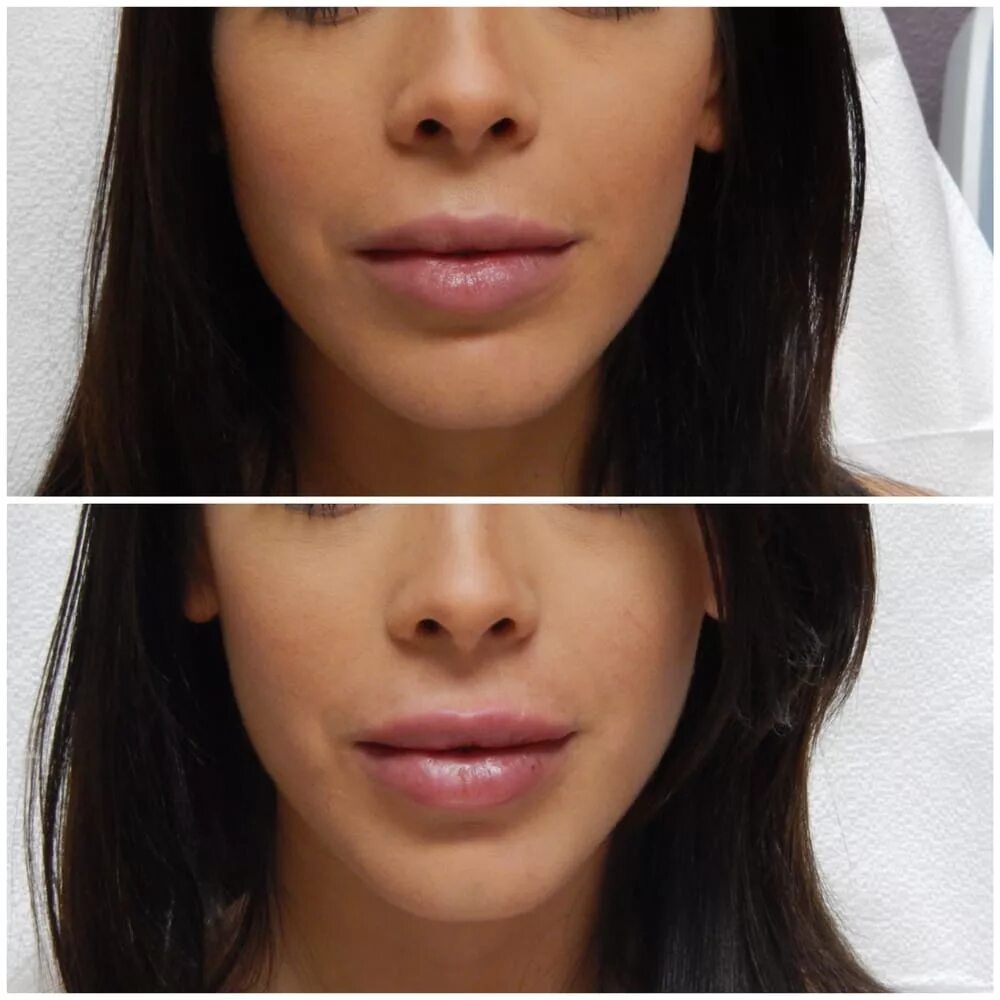 Стеллаж губы цена. Voluma Juvederm губы. Контурная пластика губ до и после.