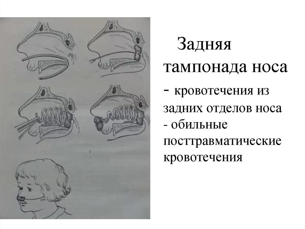 Тампонада носа при носовом кровотечении. Задняя тампонада носовой полости. Передняя и задняя тампонада носа. Задняя тампонада носа алгоритм.