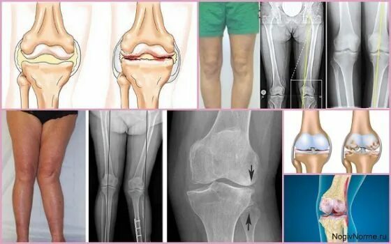 Гонартроз остеоартроз. Гонартроз 1-2 степени коленного сустава. Гонартроз- деформирующий артроз коленного сустава.