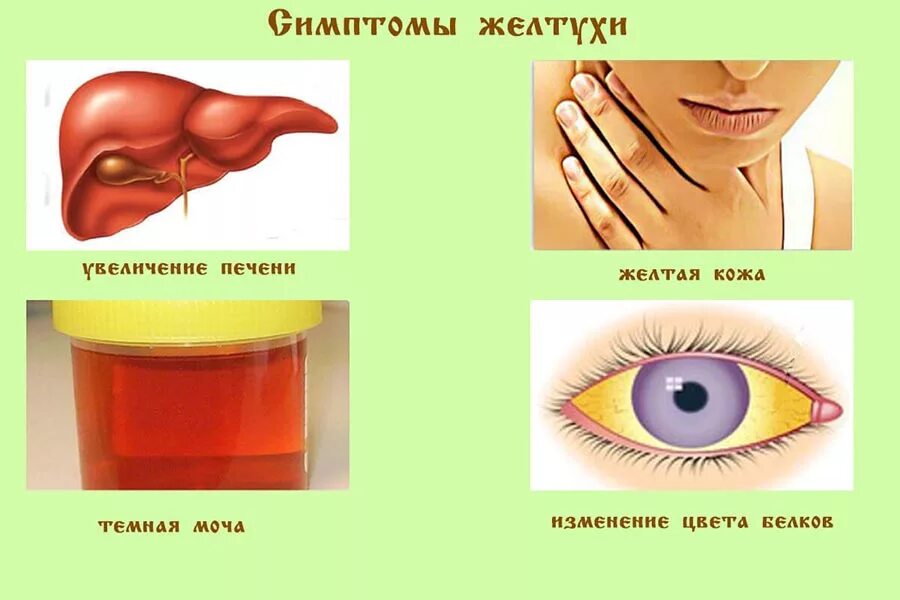 Желтуха симптомы у детей. Желтушность кожи и склер симптомы. Желтухи цвет кожных покровов. Желтушность кожи и слизистых оболочек. Желтушность кожных покровов и слизистых.