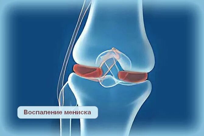 Болит ли мениск. Мениски коленного сустава анатомия. Разрыв мениска коленного сустава. Менископатия коленного сустава.