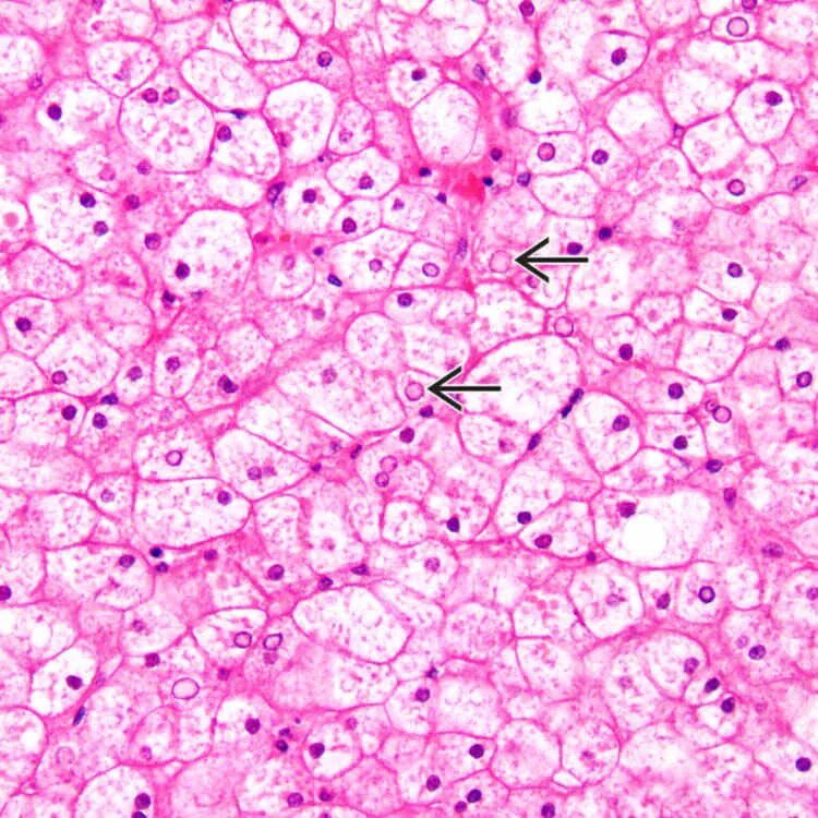 В клетках печени образуются. Болезнь Гирке гистология. Гликогеноз печени микропрепарат. Гликогеноз патанатомия.
