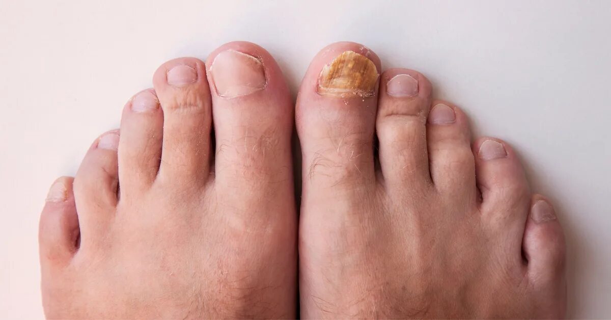 подногтевой онихолизис. сухие ногти на ногах что делать. ванночки для ног от мозолей. нога на ногу. онихомикоз гиперкератоз.