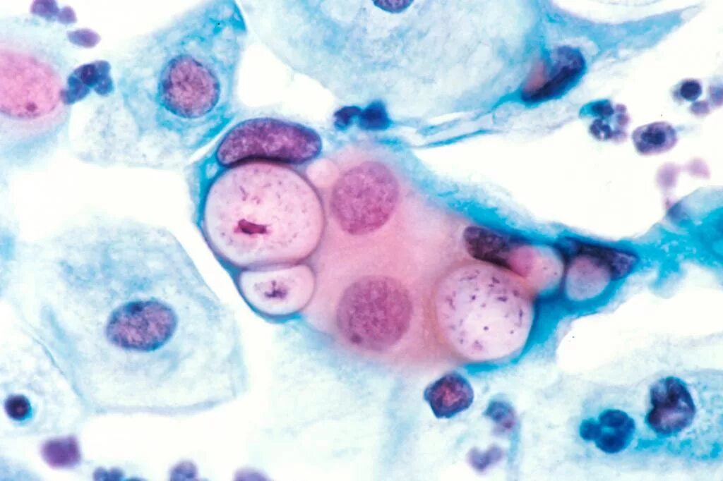 Хламидии половым путем. Урогенитальный хламидиоз микроскопия. Хламидии половым путем. Хламидии трахоматис симптомы. Урогенитальная хламидийная инфекция.