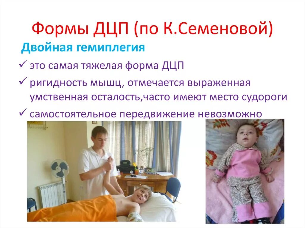 Гемиплегия симптомы