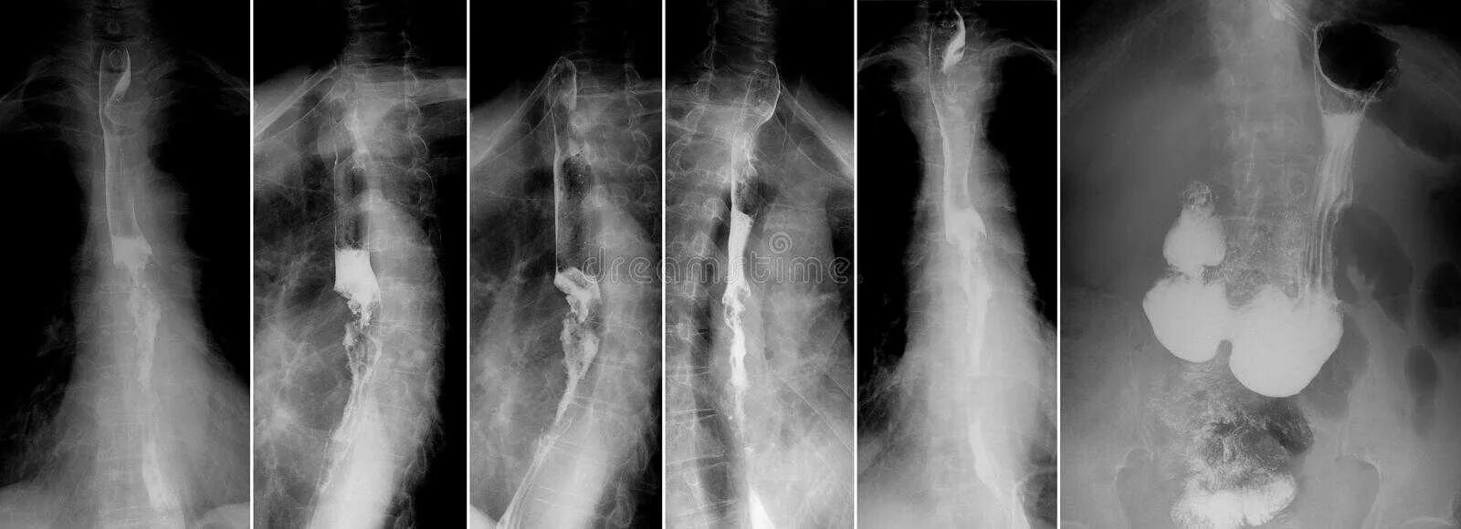 Пищевода с барием. Заболевания пищевода рентген. Опухоль пищевода рентген. Грыжа пищевода рентген с барием. Полип пищевода рентгенодиагностика.