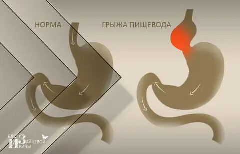 Диета пищеводной грыжи