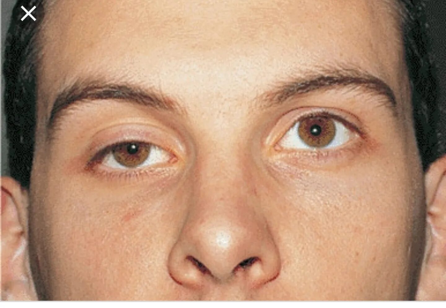 Птоз,наружная офтальмоплегия. Экзофтальм анизокория. Экзофтальм птоз офтальмоплегия. Левый глаз темнее правого