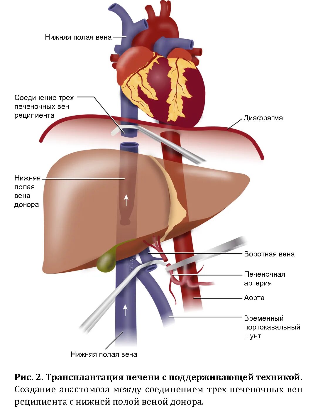 Трансплантация печени анастомоз. Гетеротопическая трансплантация печени. Схема пересадки печени. Изучение пересадки печени.