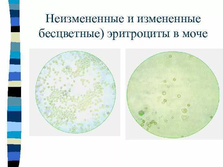 Эритроциты в моче микроскопия. Микроскопия осадка мочи эритроциты измененные. Измененные и неизмененные эритроциты в микроскопии мочи. Измененные и неизмененные эритроциты в моче микроскопия. Появление эритроцитов в моче