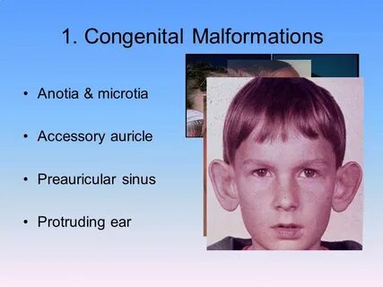 Protruding ears