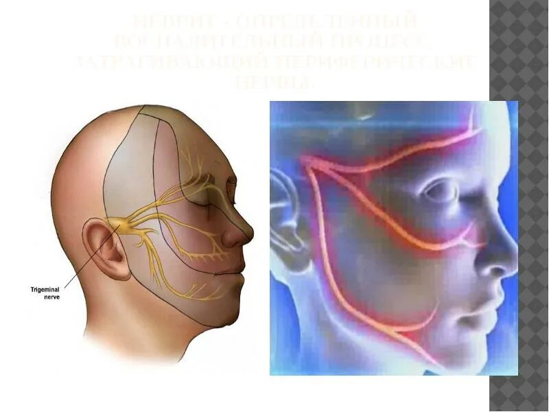 Тройничный нерв справа. Неврит тройничного нерва. Невралгия тройничного нерва боли. Невралгия ветвей тройничного нерва. Невралгия 1 ветви тройничного нерва.