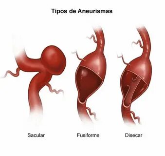 Aneurysm перевод