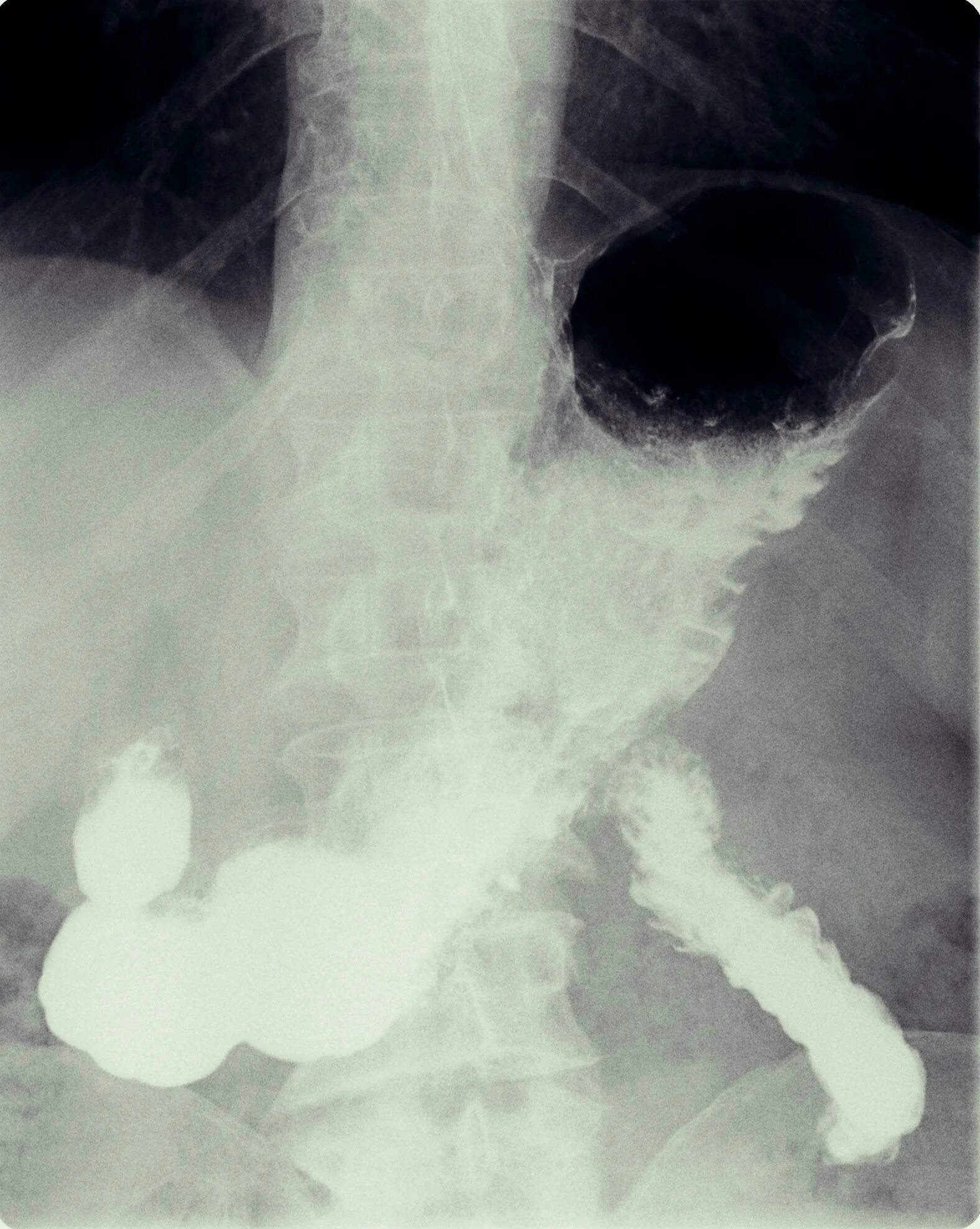 Рентгеноскопия желудка и ДПК. Рентгеноскопия желудка с барием норма. Рентгеноскопия желудка и пищевода. Рентген ЖКТ С барием в норме.
