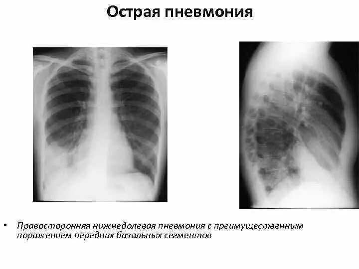 Пневмония в правой нижней доле. Внебольничная нижнедолевая пневмония рентген. Правосторонняя очаговая пневмония рентген. Пневмония нижней доли правого легкого рентген. Крупозная и очаговая пневмония рентген.