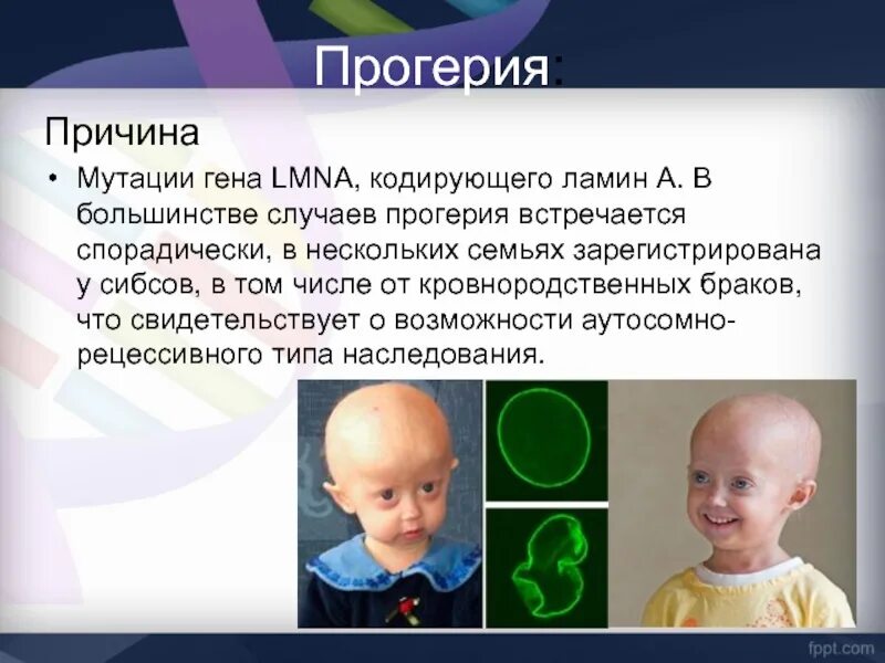 Наследственные заболевания человека мутации. Наследственные заболевания прогерия. прогерия детей – синдром хатчинсона-гилфорда. генетическое заболевание прогерия.