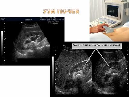 Завтракать почка узи