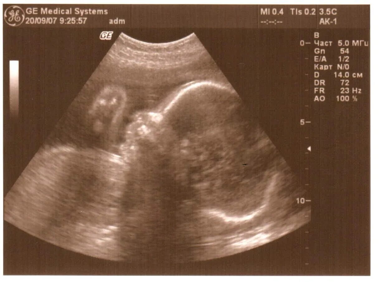 26 недель беременности что происходит с малышом. УЗИ плода 27 недель беременности. УЗИ 27 недель беременности мальчик. 27 Неделя беременности фото УЗИ. УЗИ малыша на 27 неделе беременности.