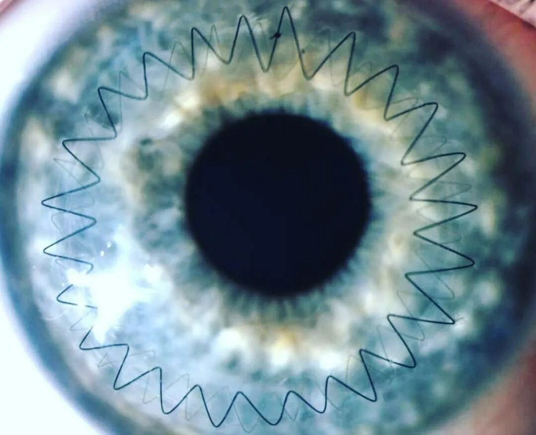 Донор зрение. Сквозная кератопластика роговицы🙈🙈🙈. Кератоконус роговицы глаз. Кератоконус имплантация роговицы.