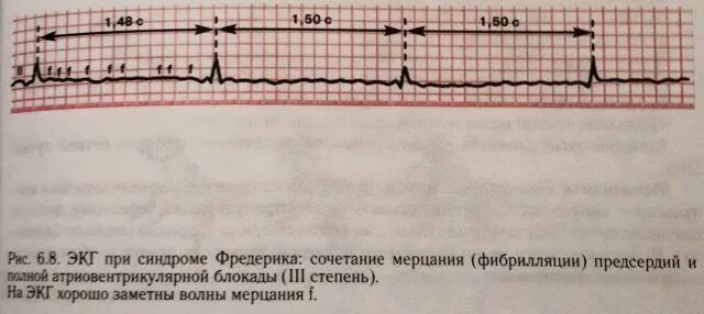 Блокада код по мкб 10. Фибрилляция предсердий с АВ блокадой на ЭКГ.