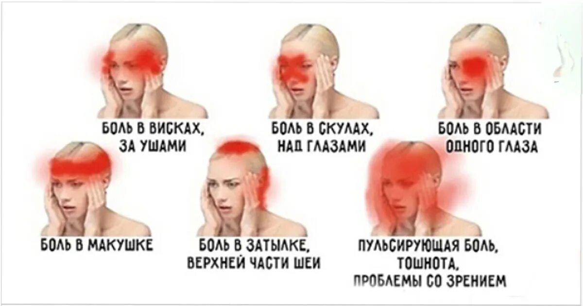 Боль в голове. Головная боль локализация. Боли в различных частях головы. Головные боли по зонам головы