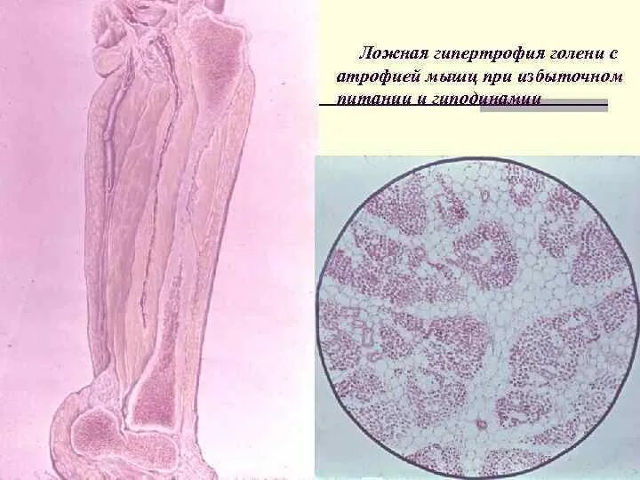 Гипертрофия полового. Атрофия мышцы патанатомия. Атрофия гипертрофия патанатомия.