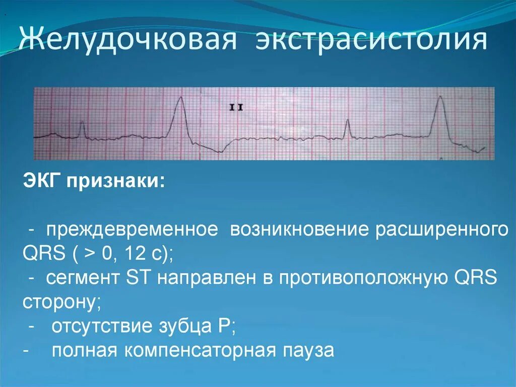 Желудочковая экстрасистолия на ЭКГ. Желудочковые экстрасистолы на ЭКГ. ЭКГ желудочковая экстрасистолия с аберрантным проведением. ЭКГ-критерий желудочковой экстрасистолии. 10 экстрасистола