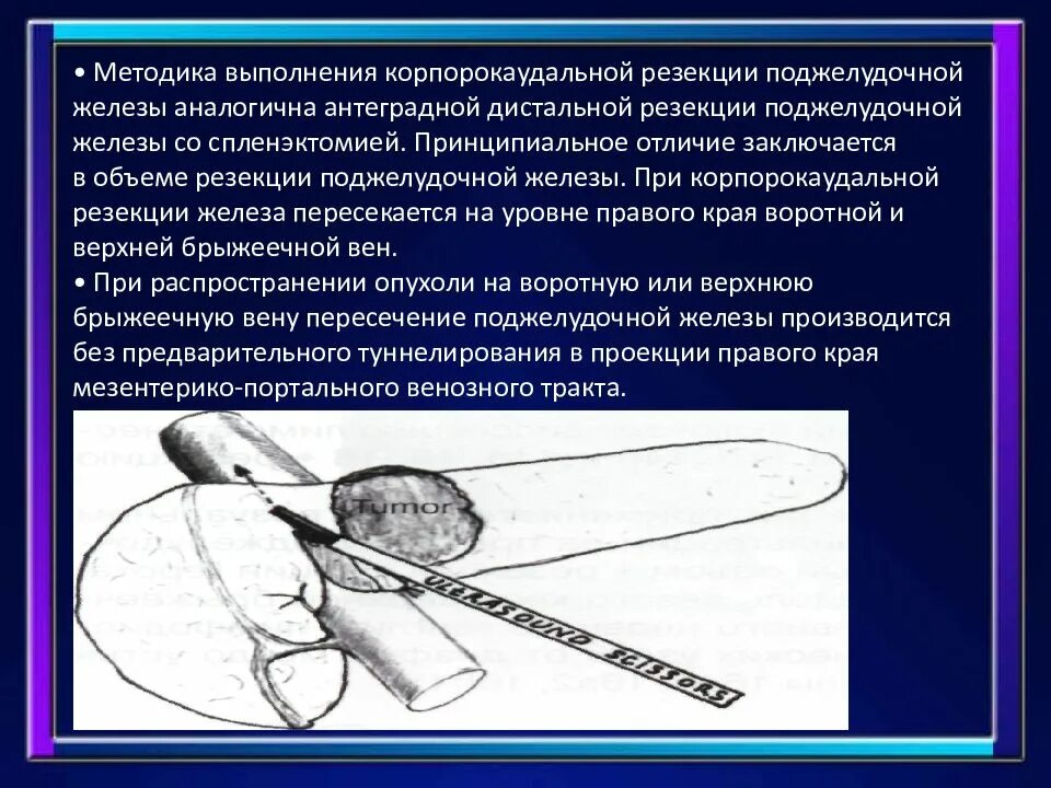 Резекция поджелудочной железы операция. Дистальная резекция поджелудочной железы. Корпорокаудальная резекция поджелудочной железы. Резекция поджелудочной железы этапы.