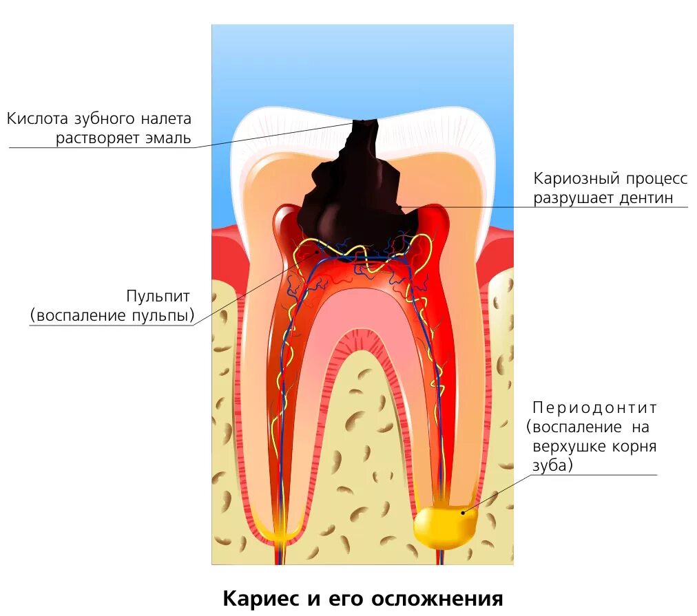 Осложнения лечения кариеса