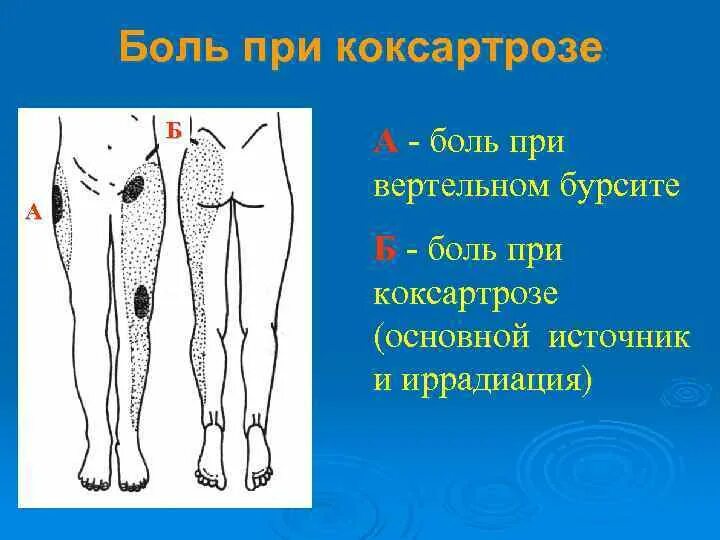 Какая боль при коксартрозе. Иррадиация боли при коксартрозе. Локализация боли в тазобедренном суставе. Локализация боли при коксартрозе тазобедренного. Радиация болей при коксоартрозе.