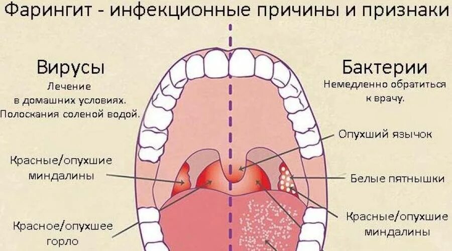 Фарингит лекарства