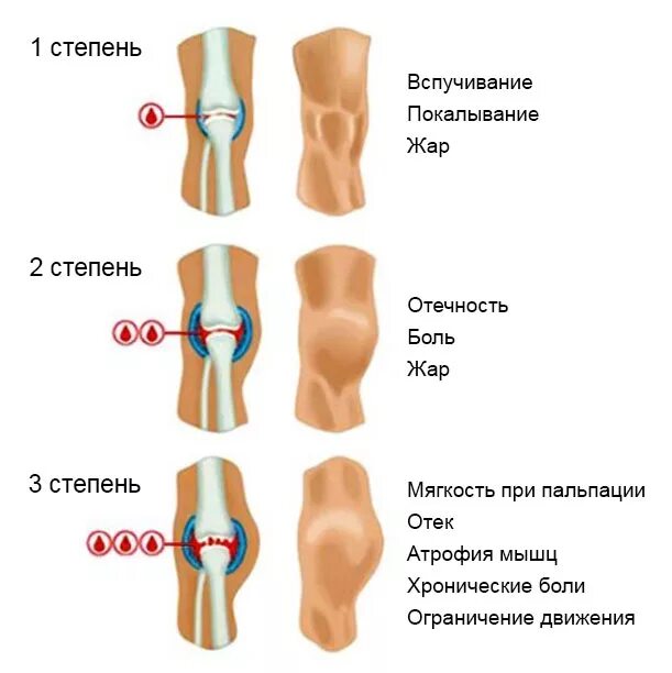 Коленный сустав по стадиям. Гемартроз коленного сустава 3 степень. Гемартроз коленного сустава 3 стадии. Посттравматический гемартроз. Гемартроз коленного сустава при травме.