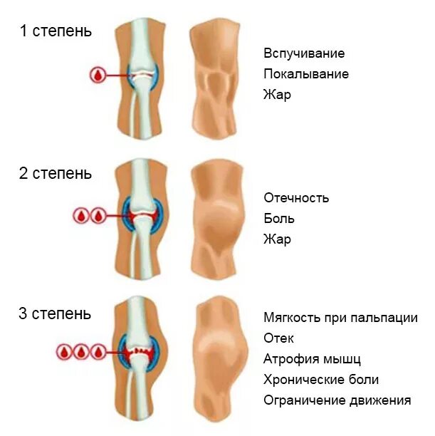 Перелом коленного сустава мкб. Гемартроз коленного сустава 3 стадии. характерными признаками коленного гемартроза. гемартроз коленного сустава диагноз. гемартроз коленного сустава при травме.