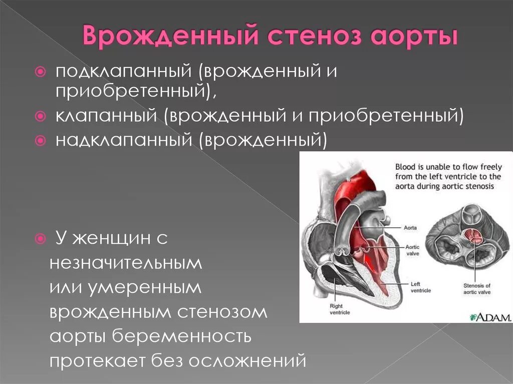 Аортальный стеноз что это такое. Изолированный аортальный стеноз врожденный. Клапанный и подклапанный стеноз аорты. Врожденный стеноз аорты. ВПС стеноз аортального клапана.